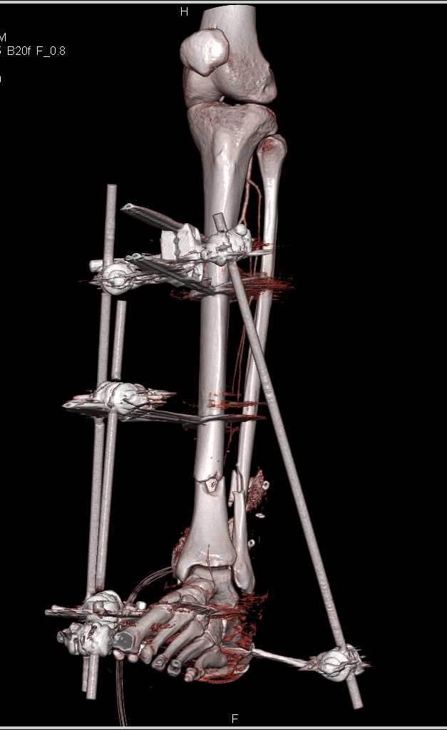 Surgical Fixation Devise for Tibia and Fibular Fractures - CTisus CT Scan