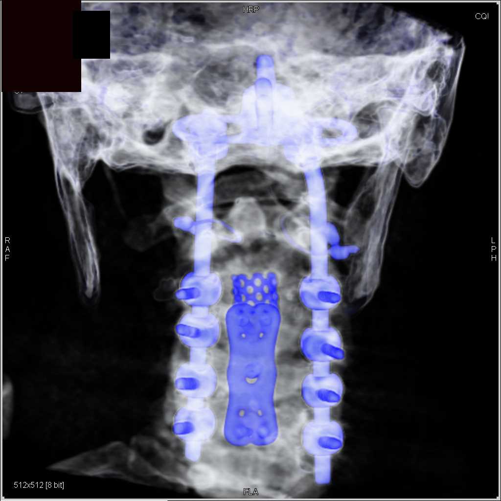 Hardware in the C-Spine - CTisus CT Scan