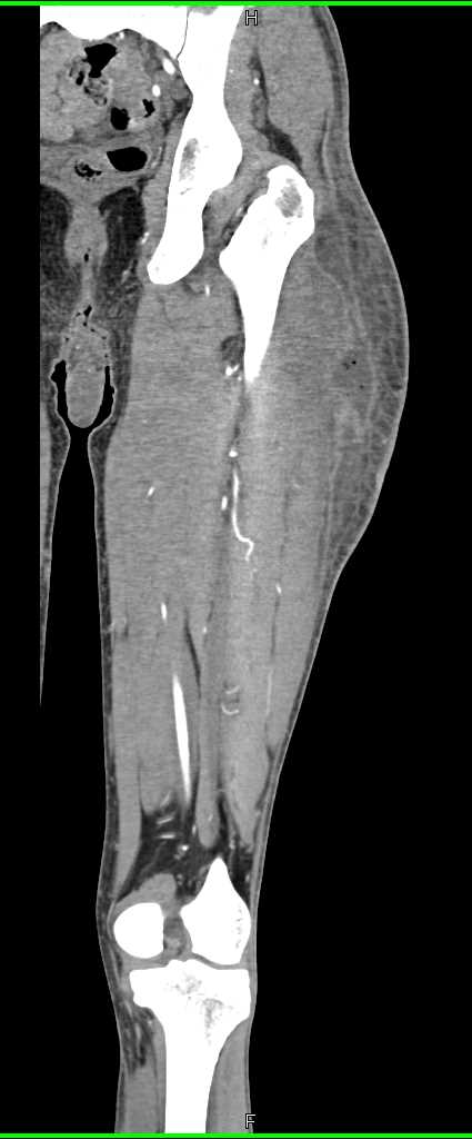 Abscess Left Thigh - CTisus CT Scan