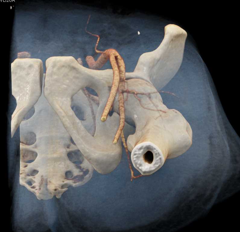 Hematoma Thigh - CTisus CT Scan