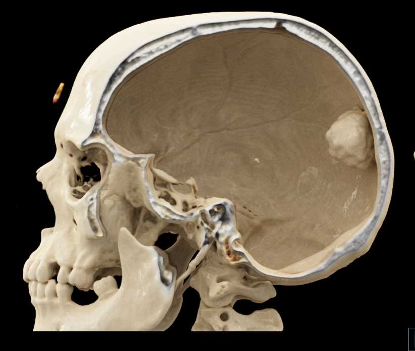 Osteoma Skull - CTisus CT Scan