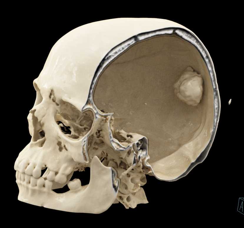 Osteoma Skull - CTisus CT Scan