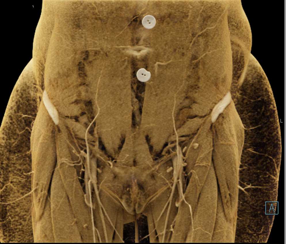 CT with 3D Mapping of Muscle and Vasculature - CTisus CT Scan