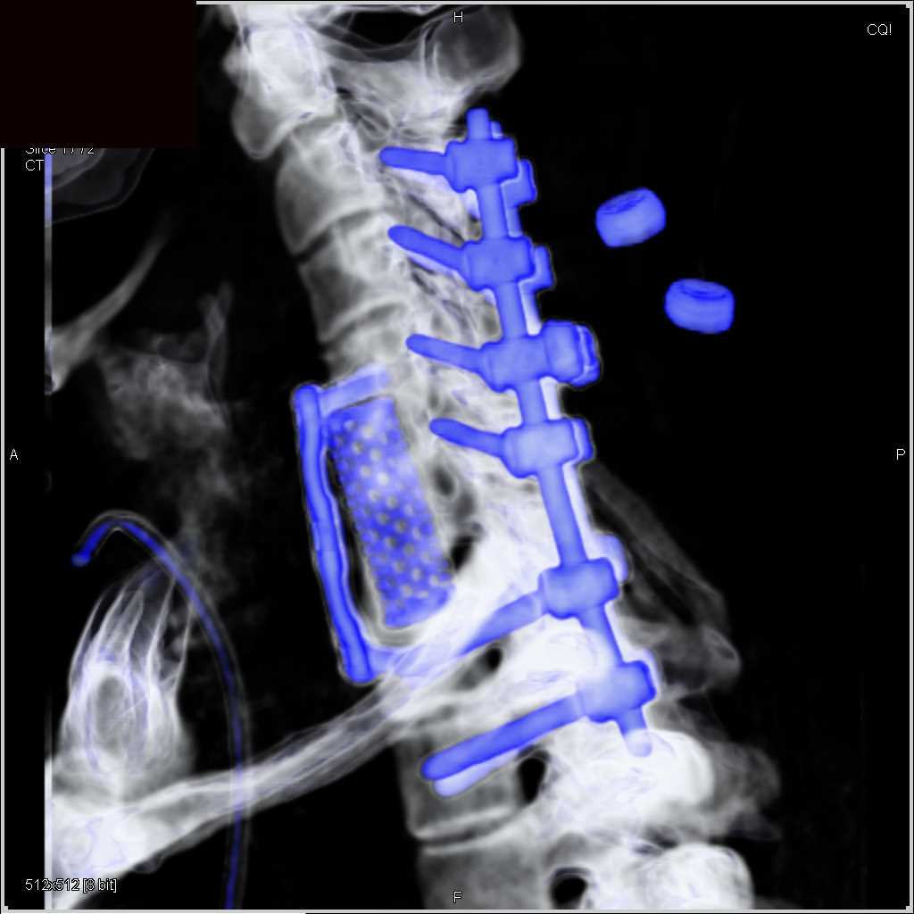 Hardware Repair Cervical Spine - CTisus CT Scan