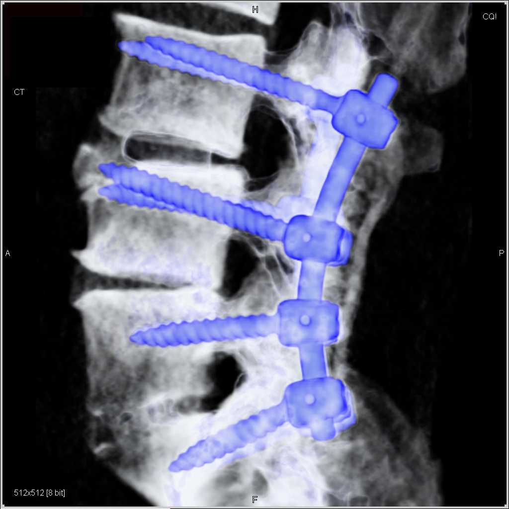 Hardware in the Lumbar Spine - CTisus CT Scan