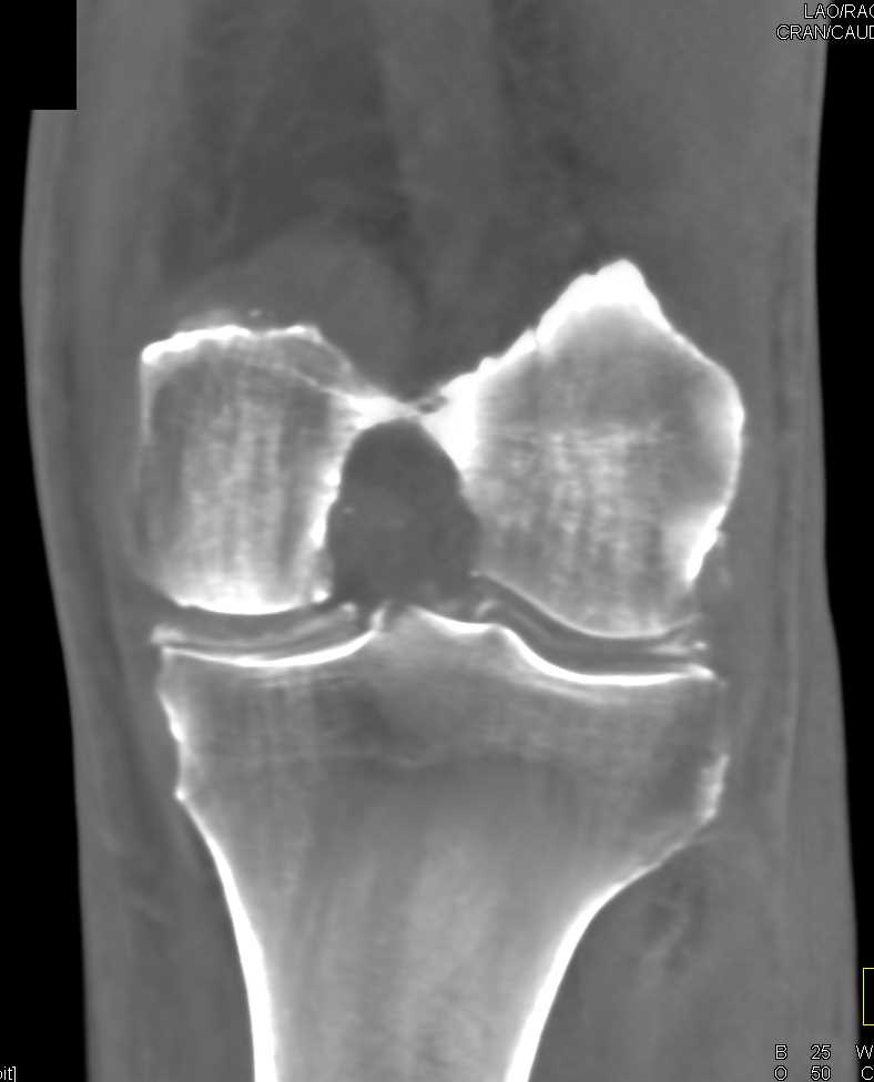 Femur Fracture - CTisus CT Scan