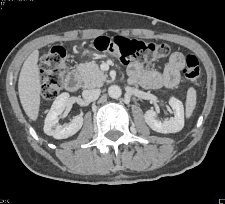 Multiple Sclerotic Bone Lesions due to Myeloma - CTisus CT Scan