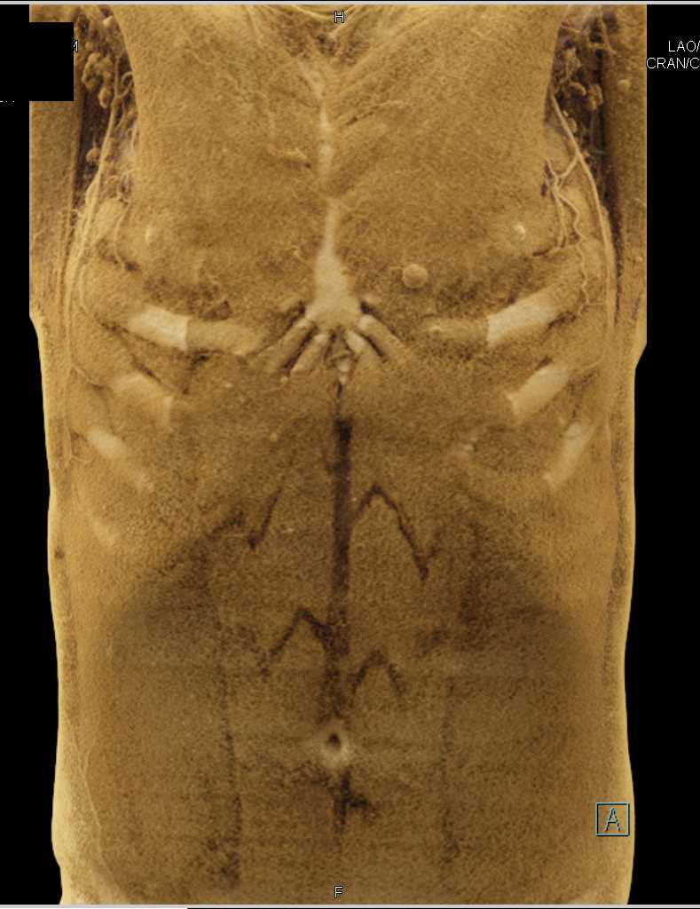 Musculoskeletal Anatomy of the Chest and Abdomen - CTisus CT Scan