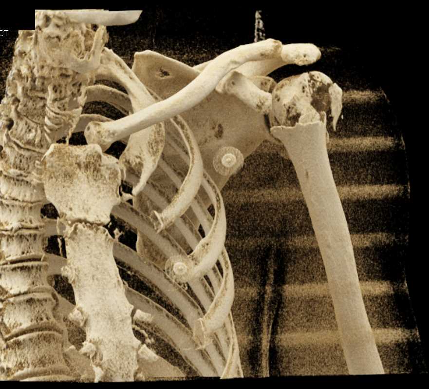 Comminuted Fracture Left Humerus - CTisus CT Scan