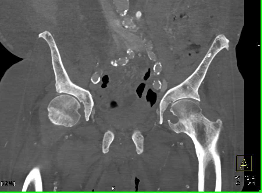 Renal Osteodystrophy Involves the Spine - CTisus CT Scan