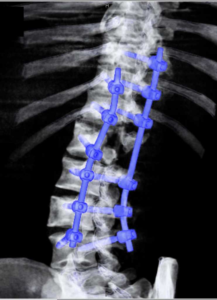 Hardware in the Thoracic Spine - CTisus CT Scan