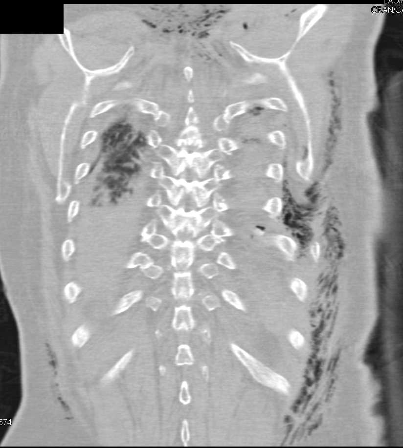 Trauma with Multiple Left Rib Fractures and Pulmonary Contusion - CTisus CT Scan