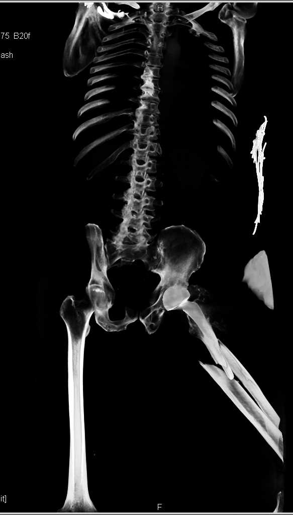 Femur Fracture with Total Hip Replacement (THR) in Place - CTisus CT Scan