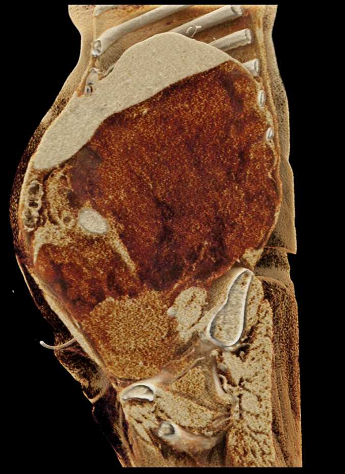 Retroperitoneal Liposarcoma - CTisus CT Scan