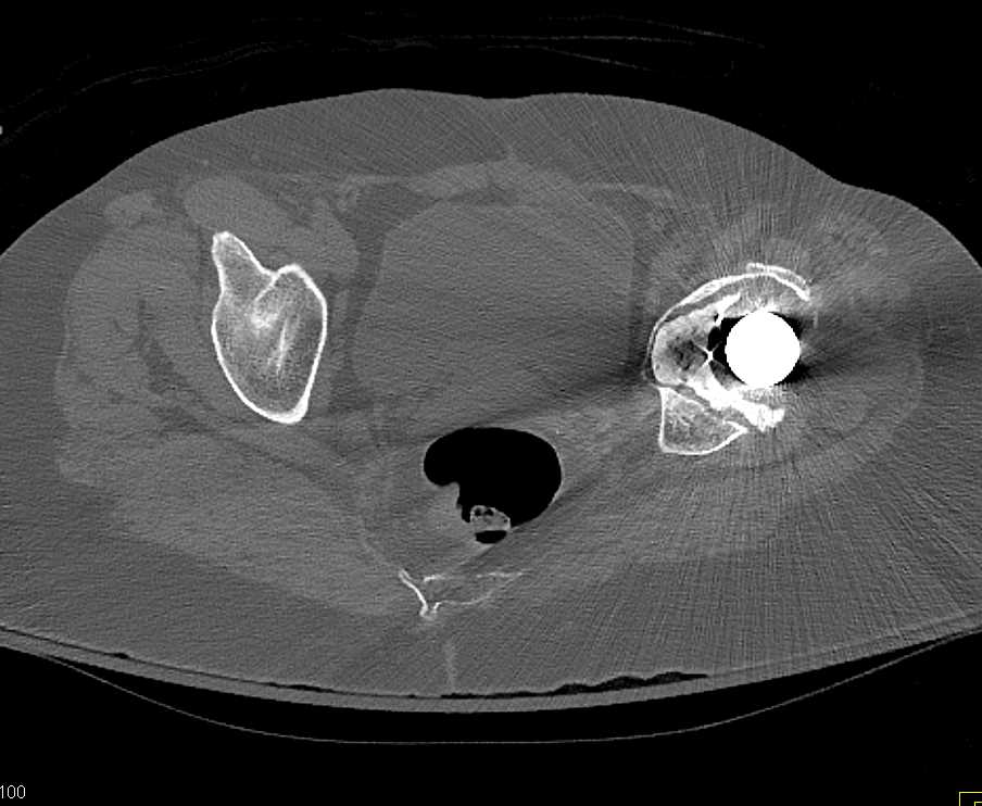 Fracture with Failed Left Total Hip Replacement - CTisus CT Scan