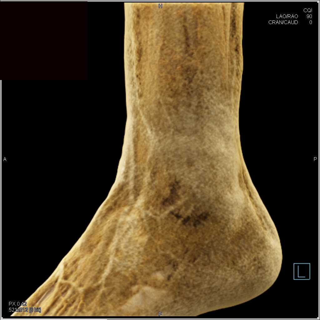 Comminuted Fracture of the Tibia and Fibula - CTisus CT Scan