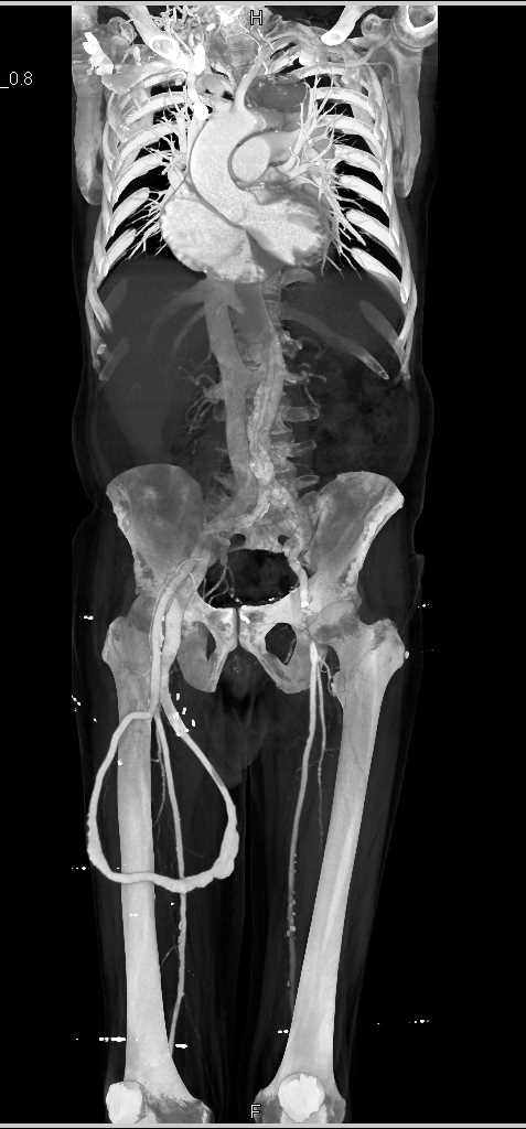 AV Fistulae in Right Upper Thigh - CTisus CT Scan