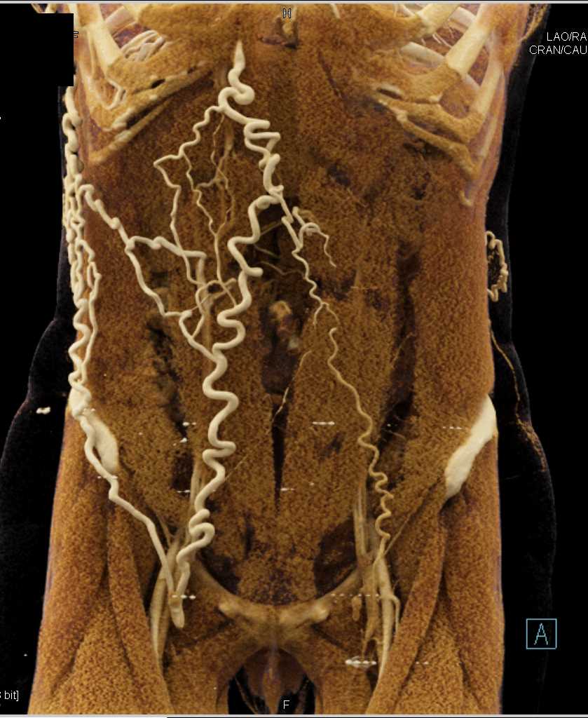 Extensive Abdominal Wall Collaterals with Distal Inferior Vena Cava (IVC) Occlusion - CTisus CT Scan