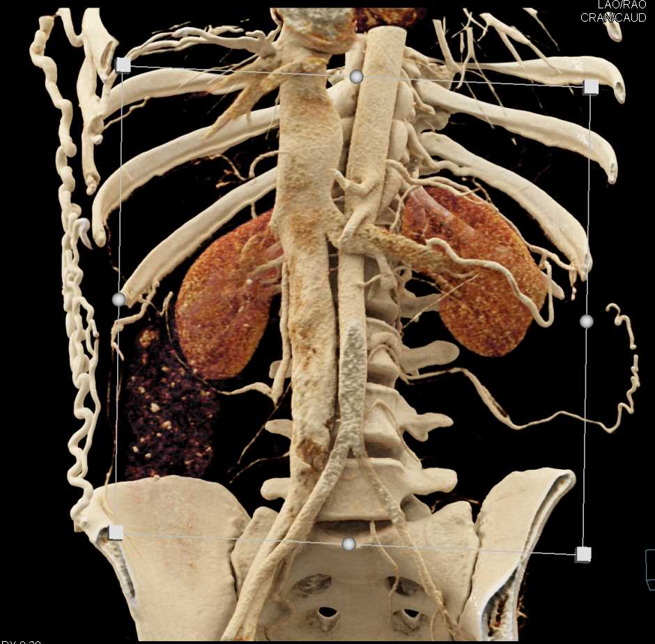 Extensive Abdominal Wall Collaterals with Distal Inferior Vena Cava ...