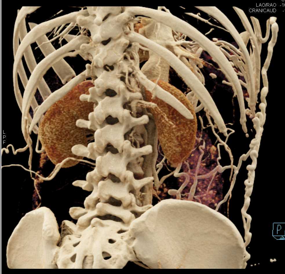 Extensive Abdominal Wall Collaterals with Distal Inferior Vena Cava (IVC) Occlusion - CTisus CT Scan