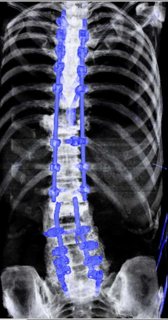 Noise Reduction for Hardware in the Spine - CTisus CT Scan