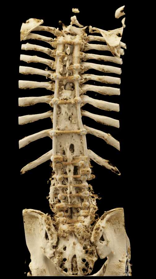 Extensive Spinal Hardware - CTisus CT Scan