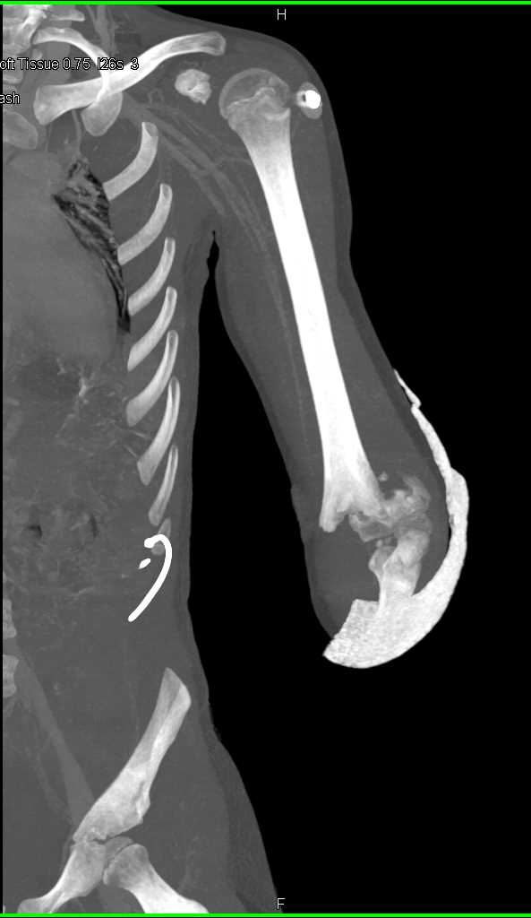 Fracture thru Epiphysis with Displacement - CTisus CT Scan