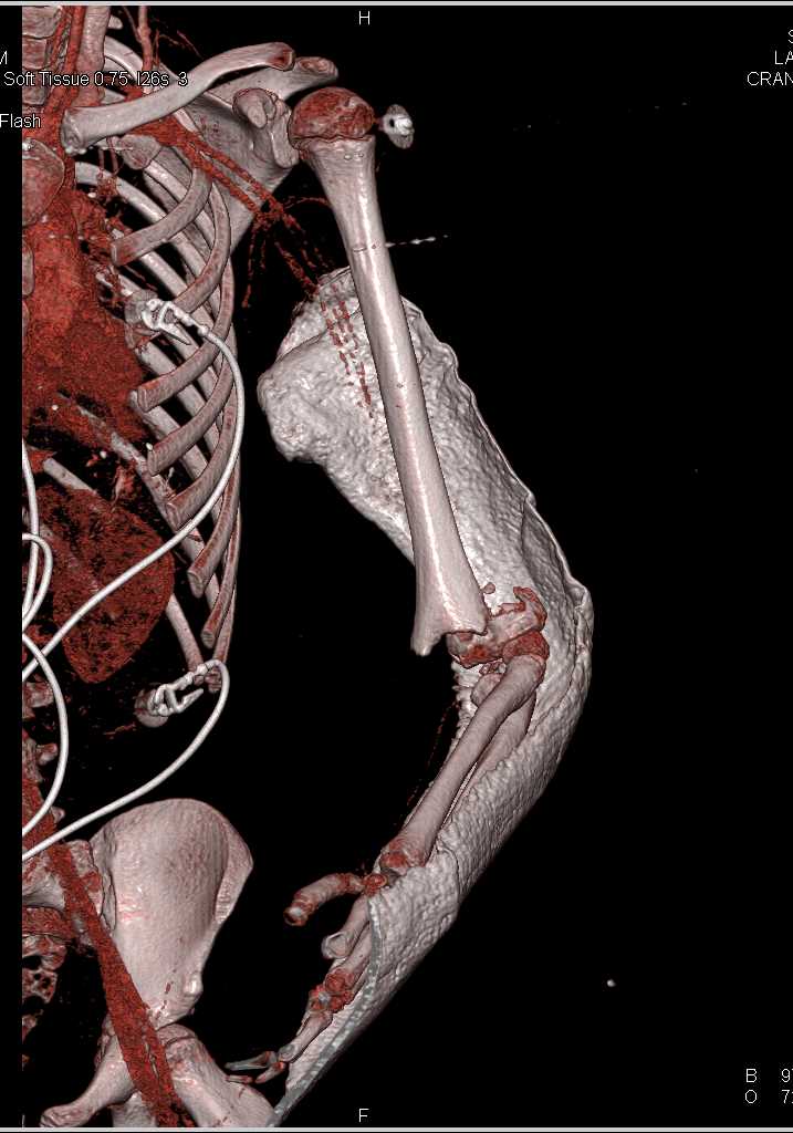 Fracture thru Epiphysis with Displacement - CTisus CT Scan