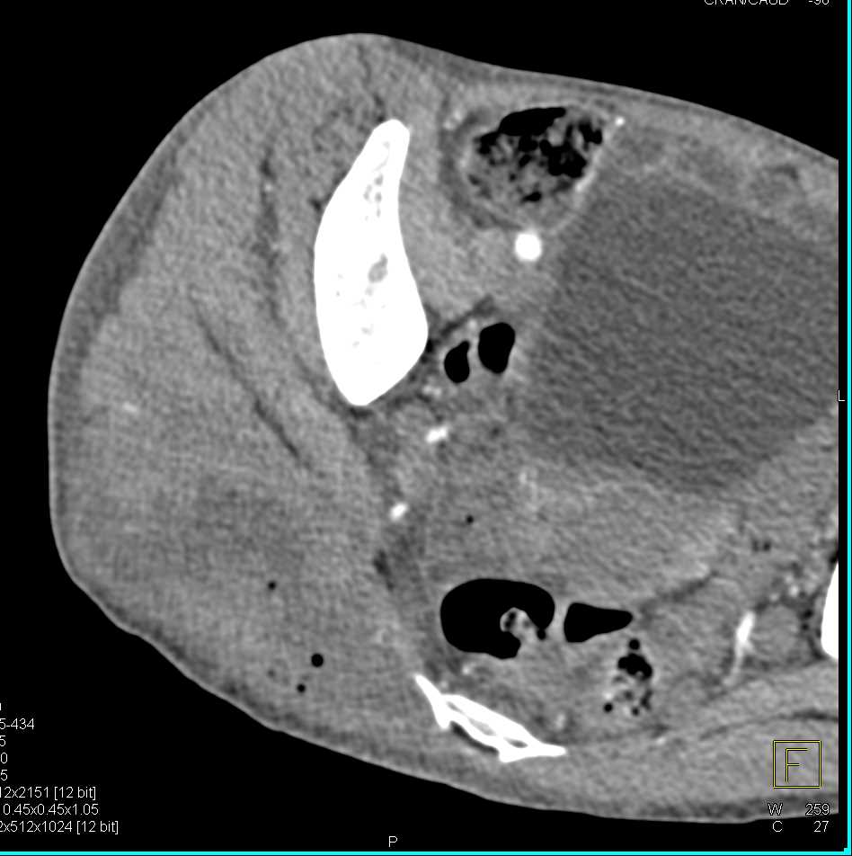 Abscess in the Buttocks - CTisus CT Scan