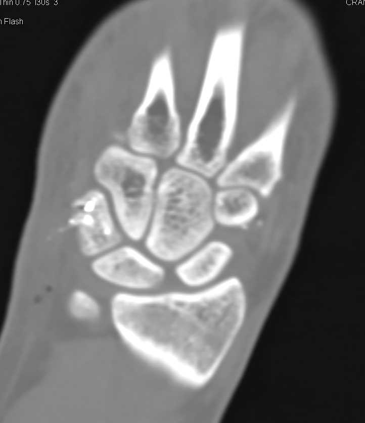 Gunshot Wound (GSW) Wrist with Carpal Fractures - CTisus CT Scan