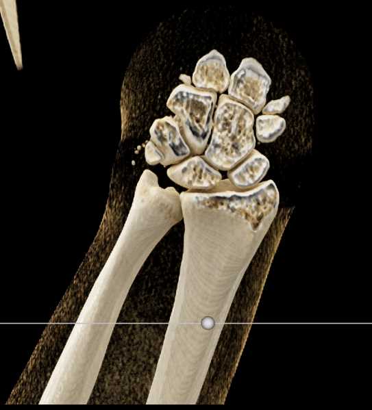 Gunshot Wound (GSW) Wrist with Carpal Fractures - CTisus CT Scan