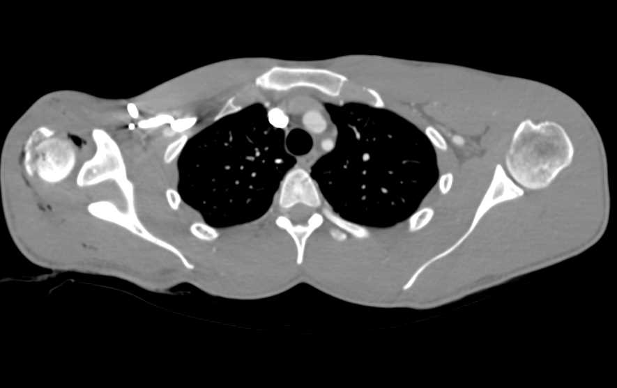 Post Trauma Including Lower Spine Fracture - CTisus CT Scan