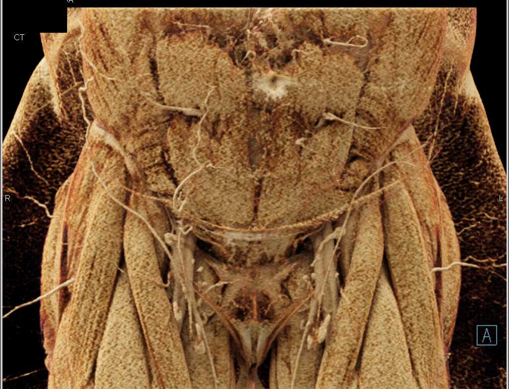 Muscles of Lower Abdomen and Pelvis - CTisus CT Scan