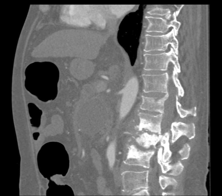 Discitis and Pancreatitis - CTisus CT Scan