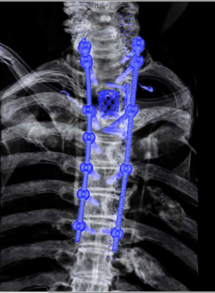 Hardware with Repair Thoracic Spine - CTisus CT Scan