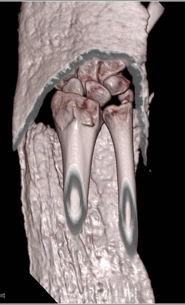 Distal Radial Fracture - CTisus CT Scan