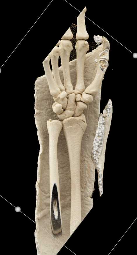 Distal Radial Fracture in Cast - CTisus CT Scan