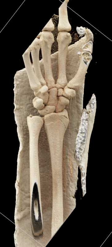 Distal Radial Fracture in Cast - CTisus CT Scan