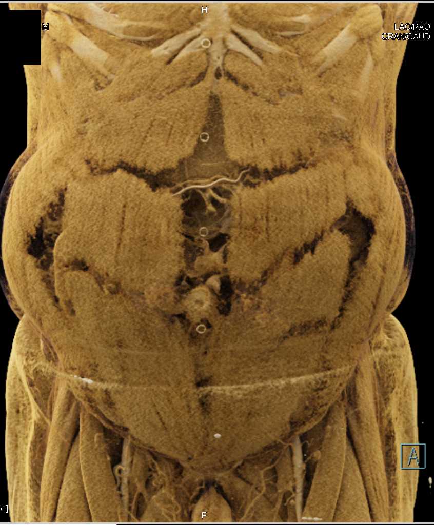 Mapping of the Abdominal Wall Musculature and Boney Skeleton - CTisus CT Scan