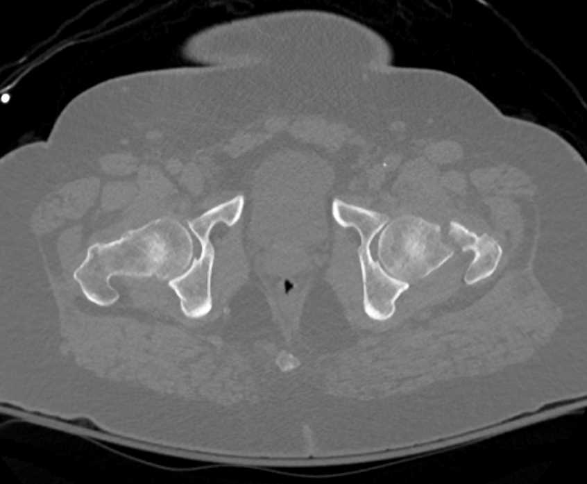 Fracture Neck Left Femur - CTisus CT Scan