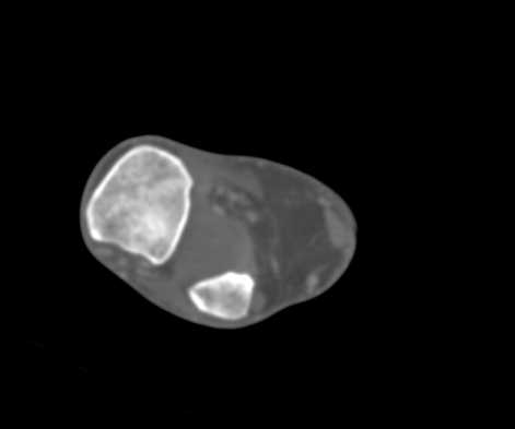 Fracture Dislocation of the Ankle - CTisus CT Scan