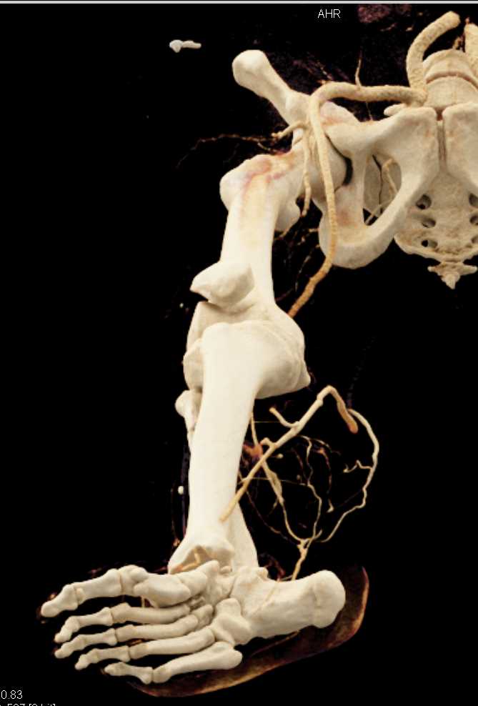 Fracture Dislocation of the Ankle with Cinematic Rendering - CTisus CT Scan