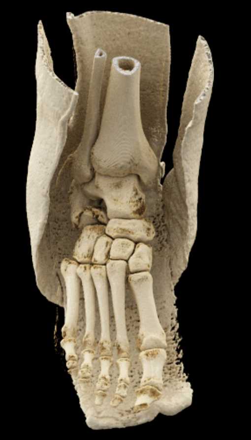 Calcaneus Fracture - CTisus CT Scan