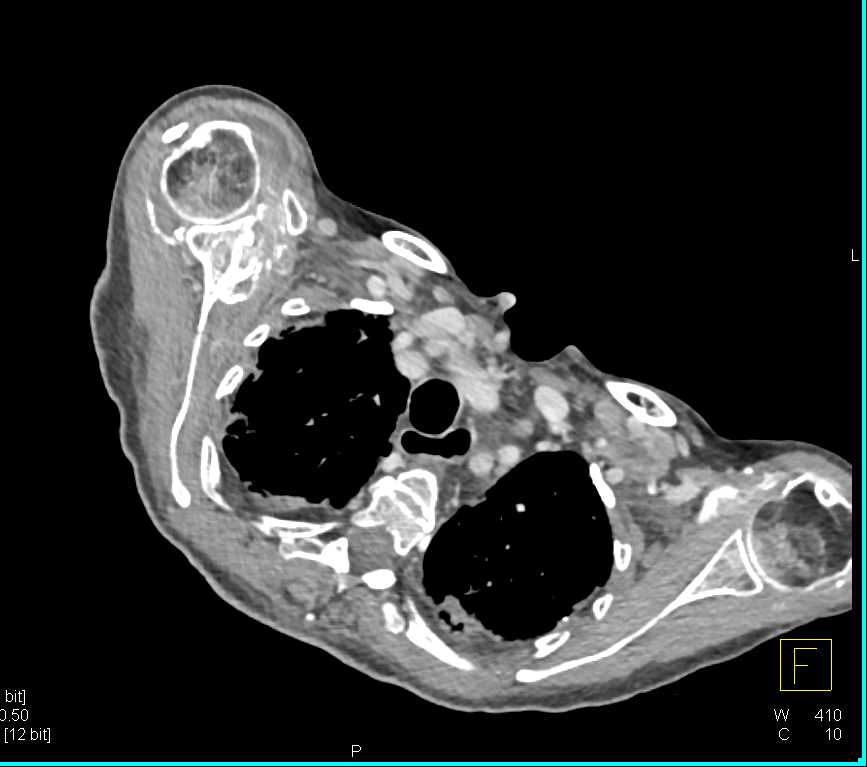 CT Arm with Heterotopic Ossification - CTisus CT Scan