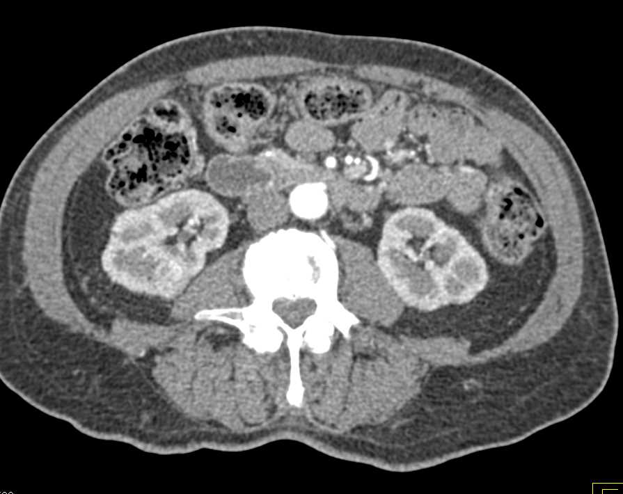 Widespread Blastic Bone Metastases - CTisus CT Scan