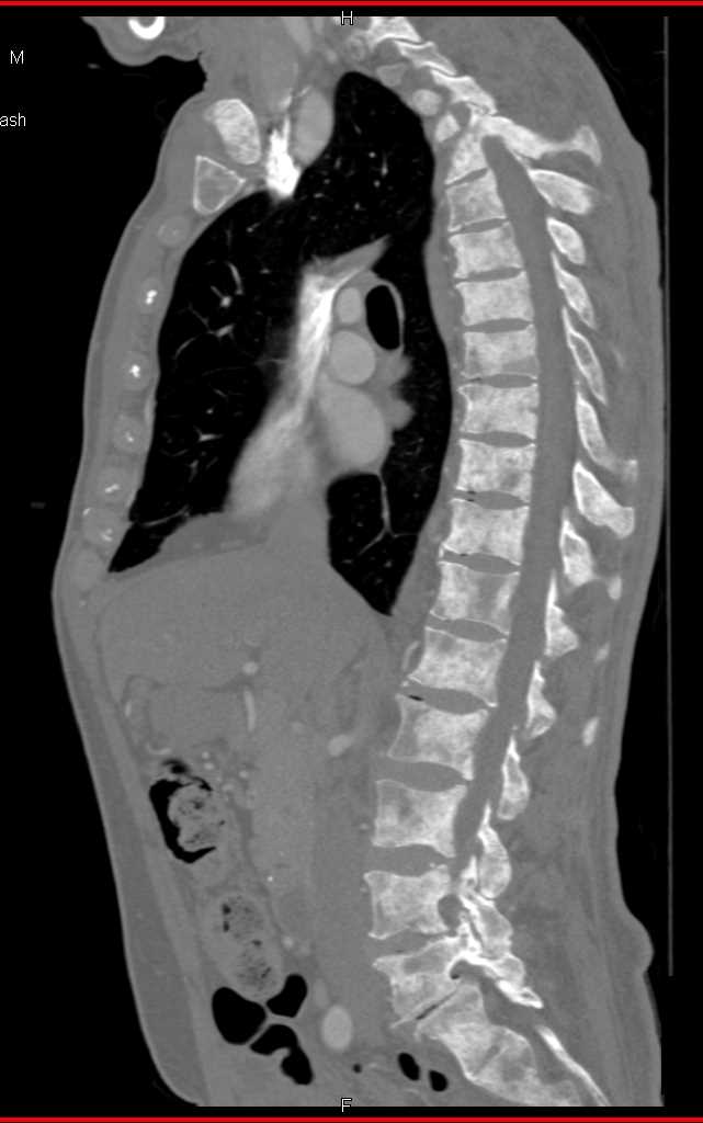 Widespread Blastic Bone Metastases - CTisus CT Scan