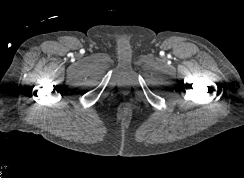 hematoma left thigh - CTisus CT Scan