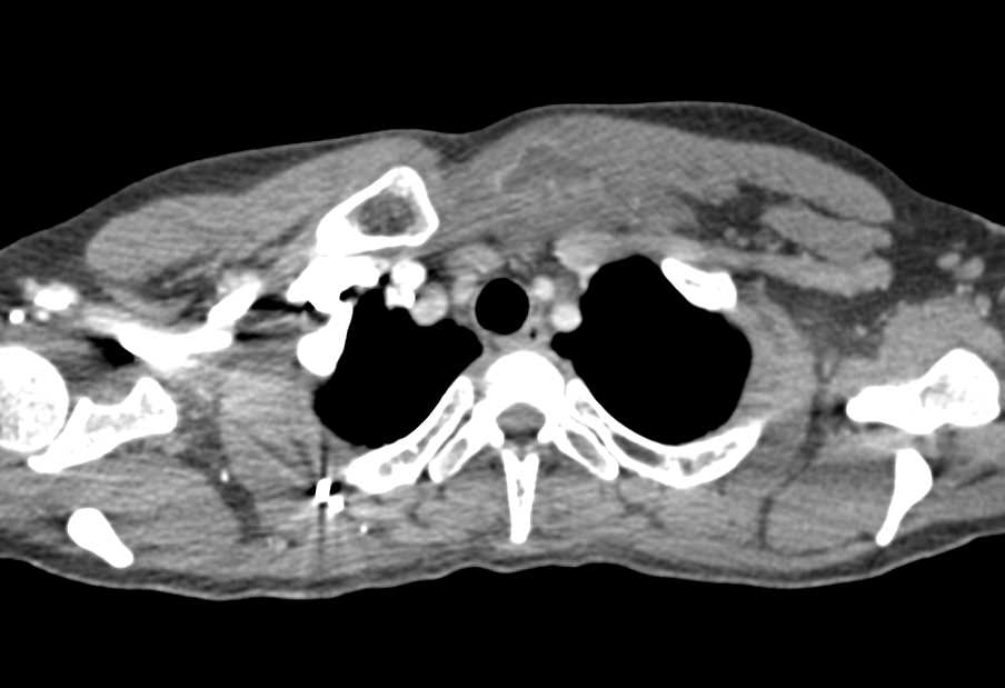 Infection Left Sternoclavicular Joint (SC Joint) - CTisus CT Scan