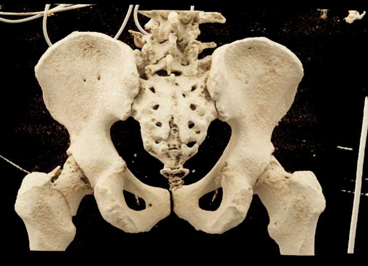 Left Femoral Neck Fracture - CTisus CT Scan