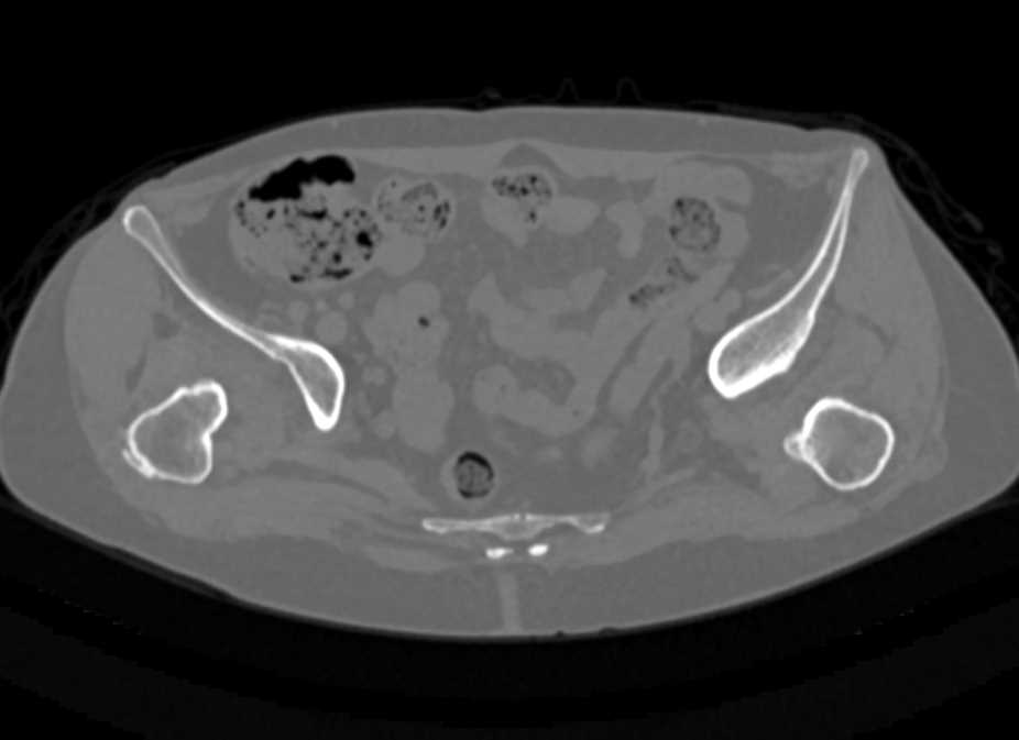 Congenital Hip Dislocations - CTisus CT Scan